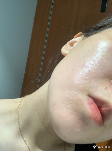 男子撸铁后擦汗 脸部感染脚气