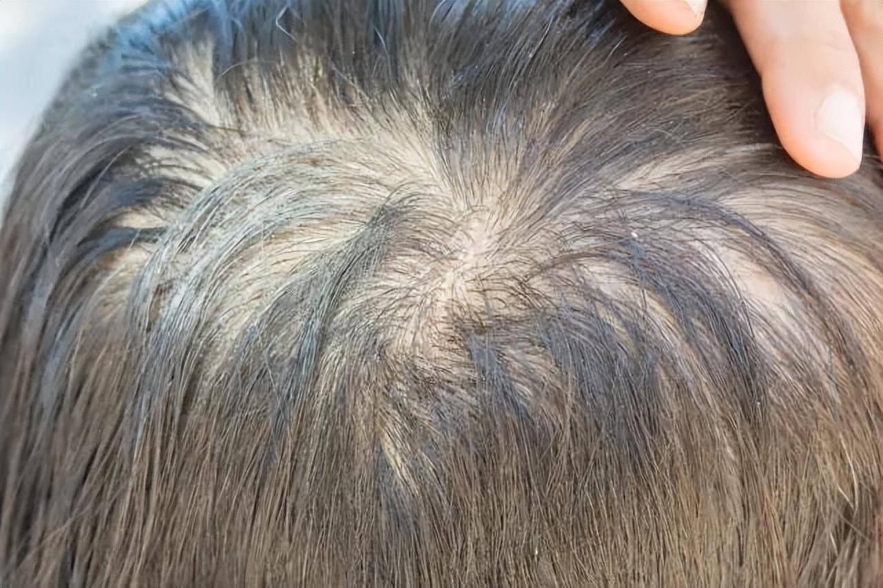 从秃头到发量王者，我用365天长头发过程视频，实践出这套生发攻略
